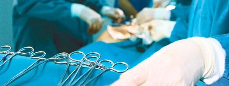 Chirurgia dell'ingrandimento del pene eseguita da un chirurgo