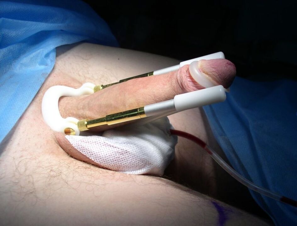 estensore dopo l'intervento chirurgico di ingrandimento del pene