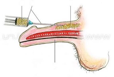 ingrandimento del pene tramite iniezione